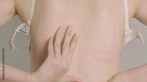 Bra marks on the back. The girl rubbed her back with her underwear. Uncomfortable bra. The wrong size underwear. Traces of clothing on the body. A woman's body. Body positive, self-love, self-care.
