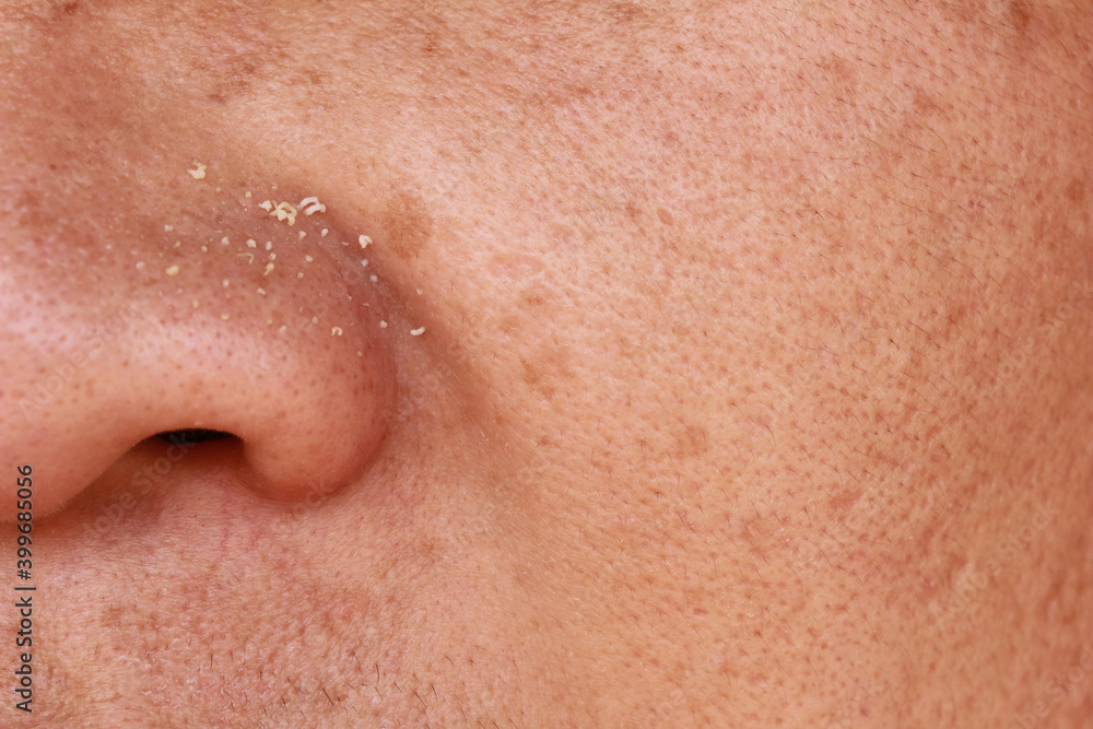 Pimples on the edge of the nose On the face of an Asian man Pimples on the edge of the nose On the face of an Asian man