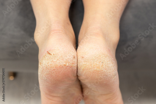 Corn callus cracks on a sole heel foot close up. Dry skin dermatology problem.