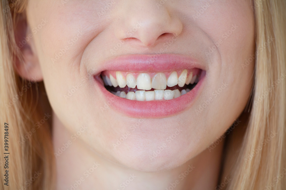 A young girl has hypoplasia in her front teeth
A young girl has hypoplasia in her front teeth