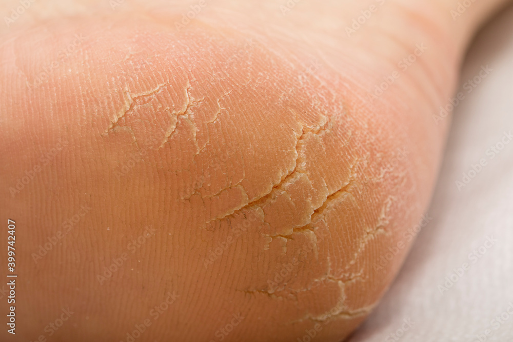 Fototapeta premium Deep cracks in the heels. Problem foot care.