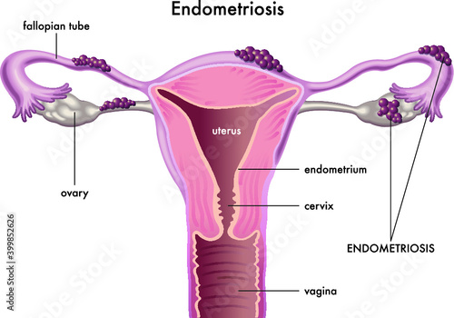 Anatomical illustration of the female reproductive system with the symptoms of endometriosis, with annotations.