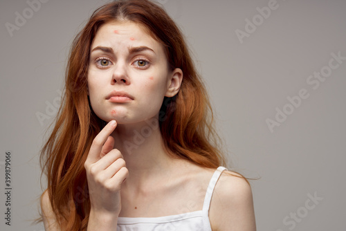 woman with loose hair pimples on face acne gesturing with hands Copy Space