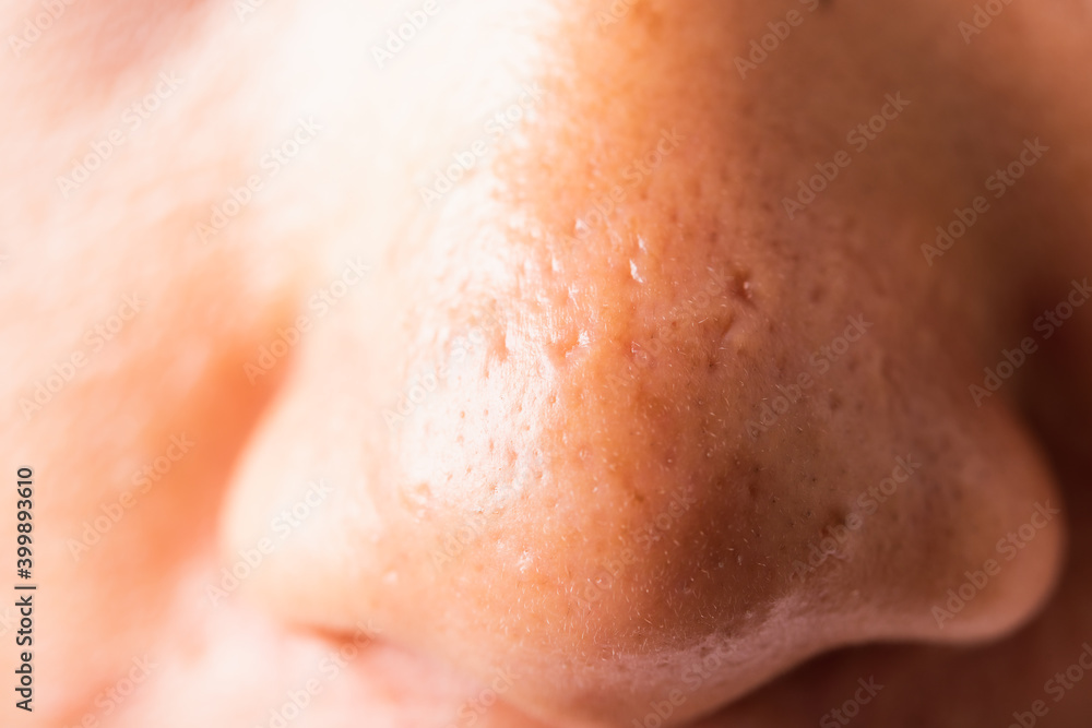Closeup Asian young woman large pores have freckles cheek oily, acne pimple on nose, studio shot isolated on white background, Healthcare beauty skin face problem concept Closeup Asian young woman large pores have freckles cheek oily, acne pimple on nose, studio shot isolated on white background, Healthcare beauty skin face problem concept