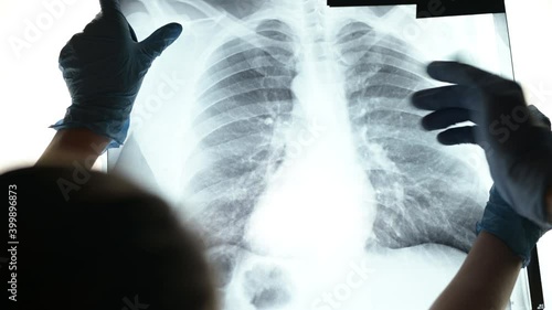 An x-ray of the lungs is discussed by doctors wearing medical gloves. Fluorography of a patient with an initial stage of pneumonia