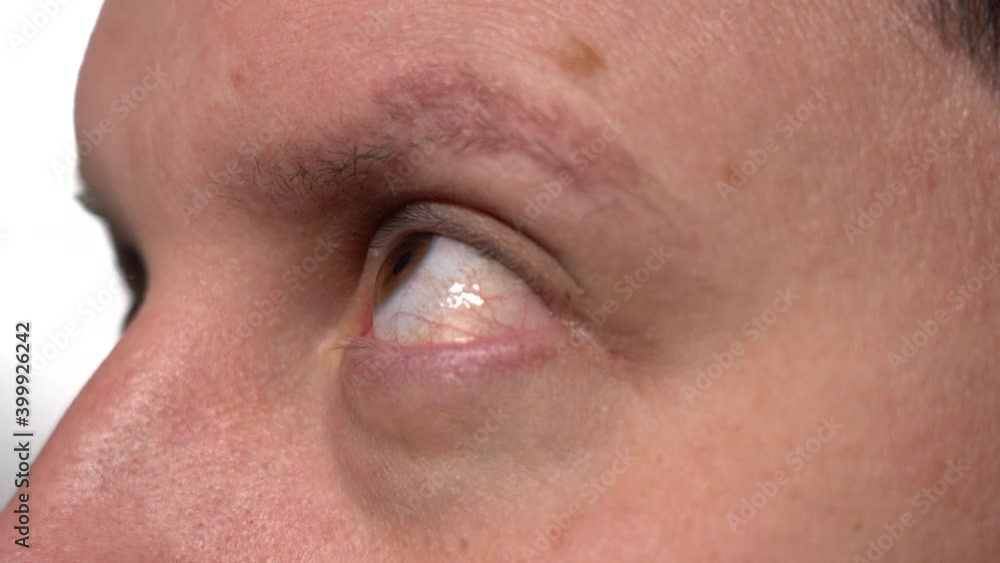 Eyeball of a young man close up. side view. A blood vessel in the eyeball. Intraocular pressure. Medical examination Eyeball of a young man close up. side view. A blood vessel in the eyeball. Intraocular pressure. Medical examination