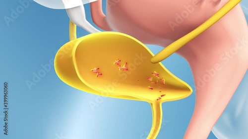 Cystitis, urinary tract infection or inflammation of the bladder. The bacteria multiplies in the bladder causing an infection. 3D animation on white background photo