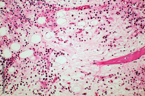 Microscope of Adenoid cystic carcinoma, rare type of cancer exist in many different body sites. This tumor occurs in the salivary glands, with close up macro 40x lens, microbiology laboratory concept.