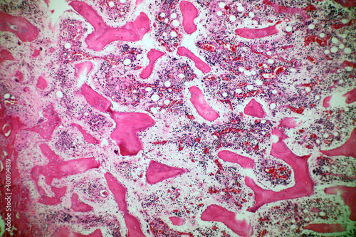 Microscope of Adenoid cystic carcinoma, rare type of cancer exist in many different body sites. This tumor occurs in the salivary glands, with close up macro 40x lens, microbiology laboratory concept.