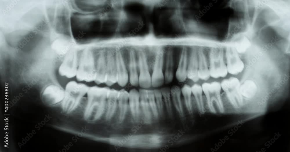 Tooth Front View Horizontal x-ray dental tracking of human teeth, human face bones ...
