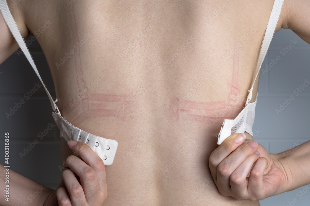 Foto de Bra marks on the back. The girl rubbed her back with her underwear. bra
