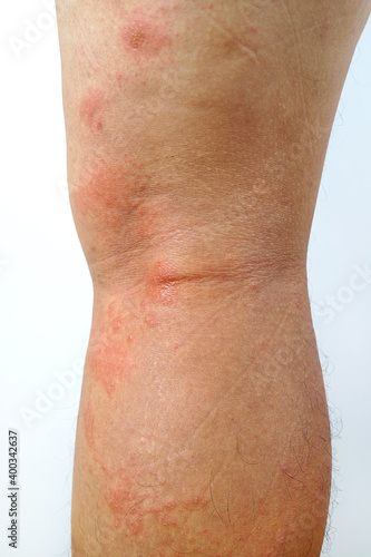 A close-up of bad psoriasis on a person s leg. Eczema allergy skin  dermatologic diseases. 