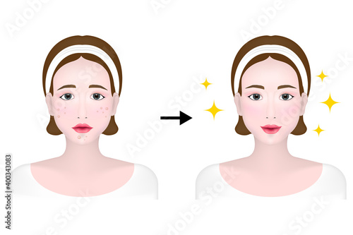 Women before and after using acne cream, Blackhead, Whitehead, Papule, Pustule, Skin problems