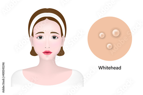 Women and whitehead acne, Skin problem vector