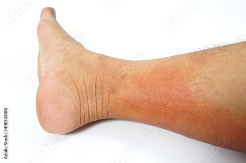 A close-up of bad psoriasis on a person's leg. Eczema allergy skin, dermatologic diseases. 