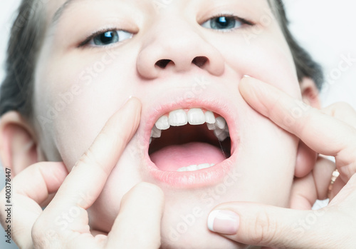 Fotografie The dentists hands open the girls mouth to check the condition of the teeth during the examination