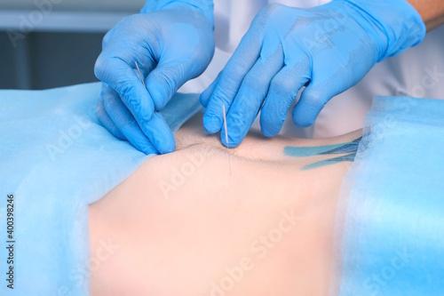 Man doctor acupuncturist in gloves is inserting acupuncture needle to woman's abdomen. Woman patient is lying on couch in hospital, closeup side view. Chinese medicine alternative in European world.