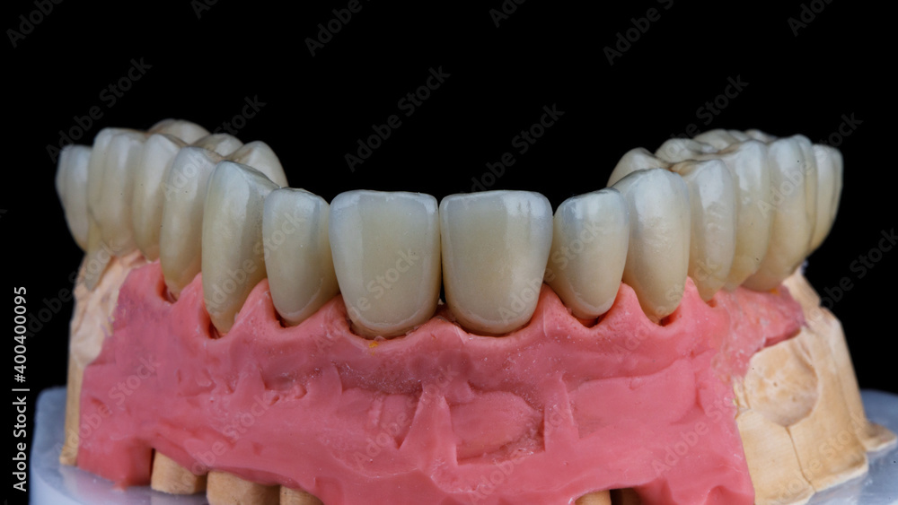 set of dental veneers and crowns made of high-quality ceramics, on a model with a black background set of dental veneers and crowns made of high-quality ceramics, on a model with a black background