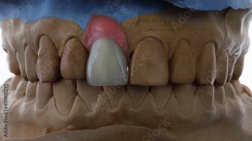 composition of the dental model and the ceramic crown of the central incisor made of high-quality ceramic