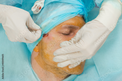 A man doing mesothreads and Thread Lifting, Cosmetic procedure to eliminate signs of aging. 