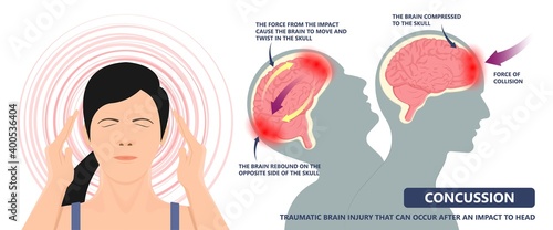 Brain Injury mild post head bleed sport loss second bump blow jolt hit skull ear contact hockey trauma fall pain athlete ball  rugby play 