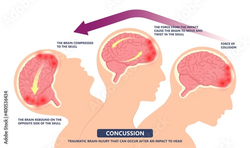 Brain Injury mild post head bleed sport loss second bump blow jolt hit skull ear contact hockey trauma fall pain athlete ball  rugby play 