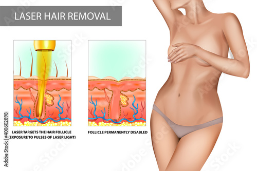 Laser hair removal. Process of hair removal by means of exposure to pulses of laser light