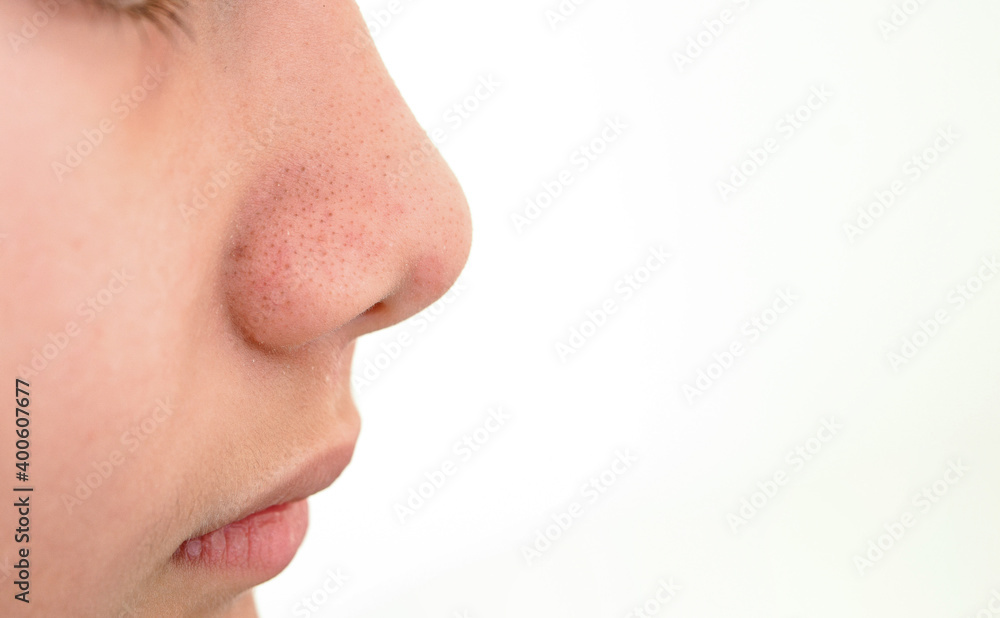 close up blackhead pimples on the nose of a teenage boy. Skincare acne problem in a teenager boy isolated on white background with copy space for texts. close up blackhead pimples on the nose of a teenage boy. Skincare acne problem in a teenager boy isolated on white background with copy space for texts.