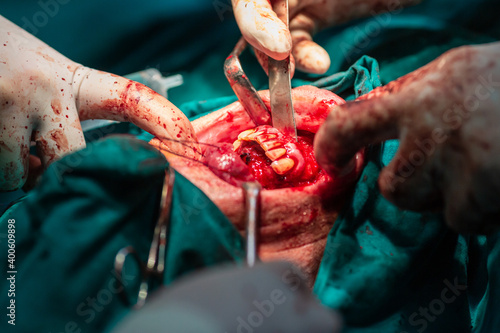Jaw tumor removal by maxillofacial surgeons in hospital
 photo