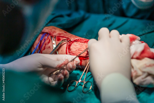 Billede på lærred Radial forearm free flap microvascular surgery in hospital