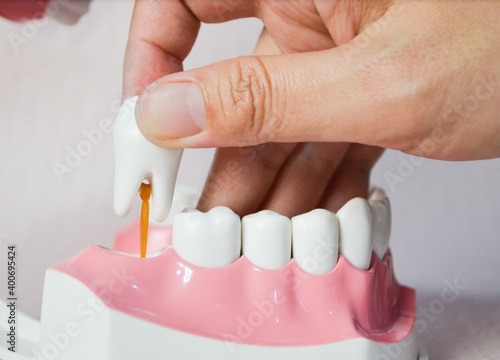 Obraz na plátne Hand extracting a tooth model,Hand pulling out a tooth model
