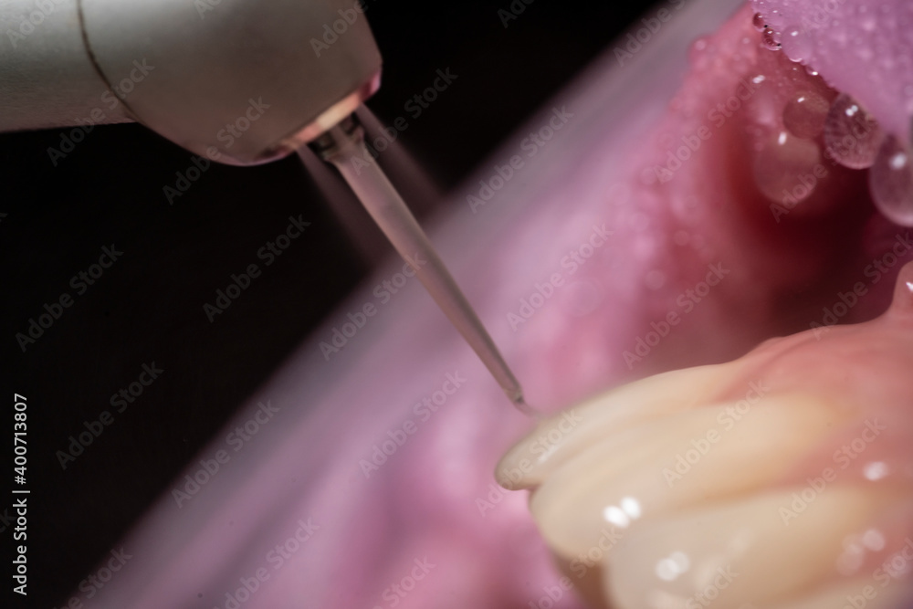 Closeup of laser etching teeth procedure Closeup of laser etching teeth procedure