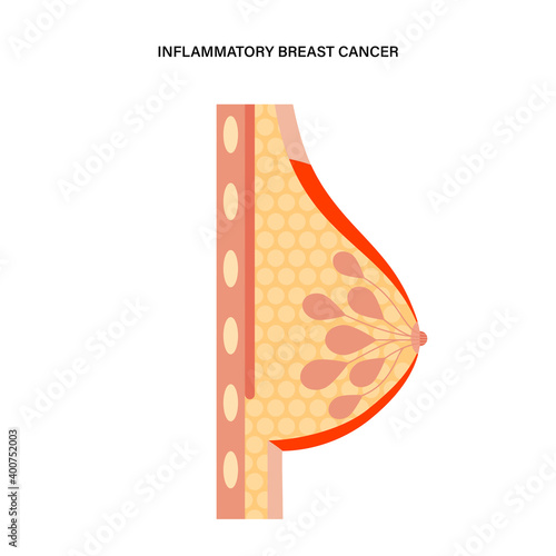 Breast disease concept