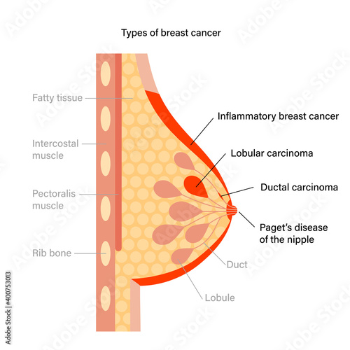 Breast disease concept