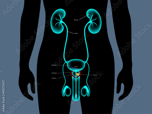 Prostate cancer concept