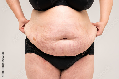 Tummy tuck, flabby skin with stretch marks on a fat belly, plastic surgery concept photo