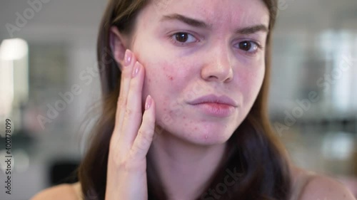 Girl with the problem of acne during puberty, looks at herself in the mirror. Close-up
