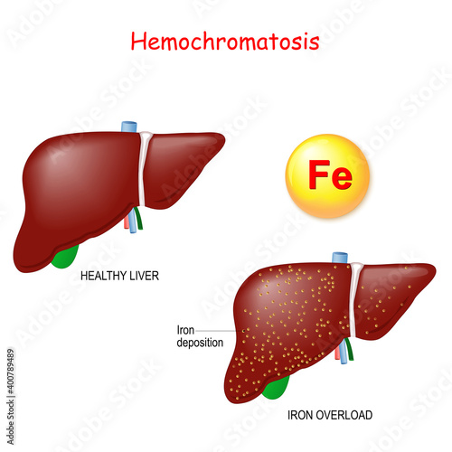 Hemochromatosis or Iron overload. Healthy liver and liver with  iron deposits.