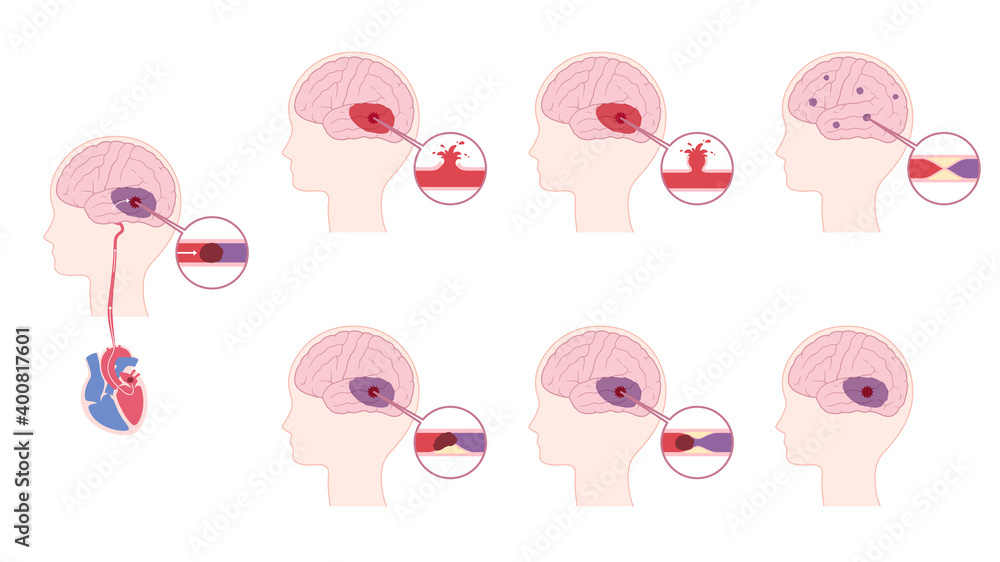 脳卒中の原因のイラスト素材セット 脳梗塞 脳出血 Stock Vector Adobe Stock