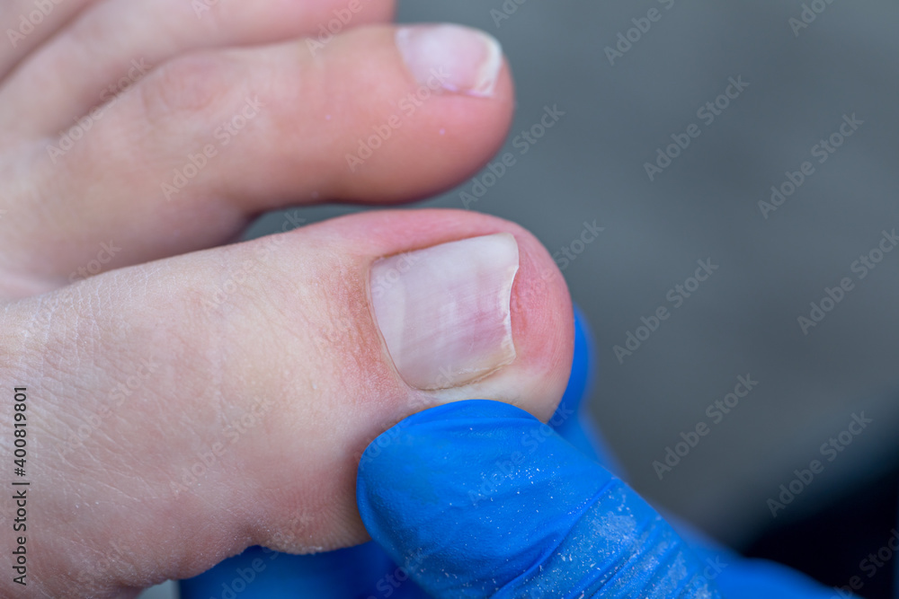 Fototapeta premium Sick nail with fungus after treatment. Medical pedicure in the salon.