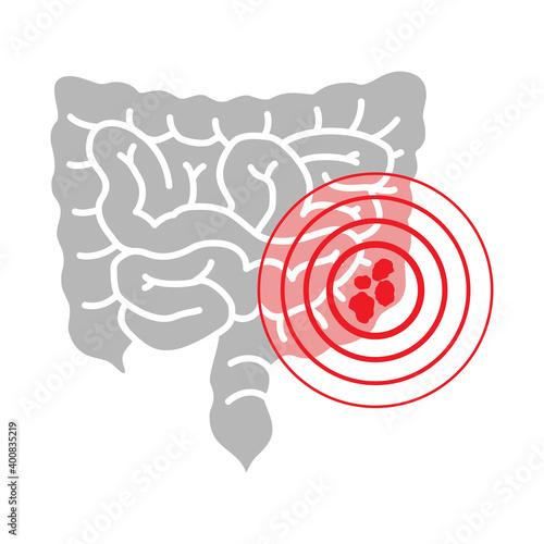 Colon cancer - intestine and pain circles
