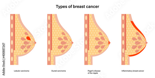 Breast disease concept