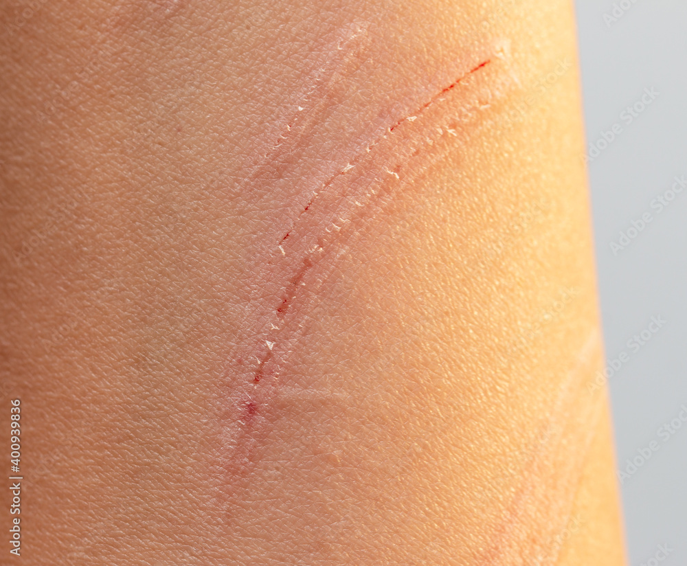 Fototapeta premium scratch on the skin of the hand