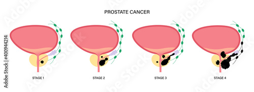 Prostate cancer concept
