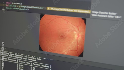 Diabetic and Hypertensive retinopathy Glaucoma Detection with Neural Network ML