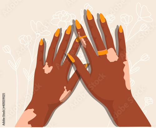 Girl hands.World vitiligo day vector illustration.Accepting oneself. Self love. Skin disease. Body positive.