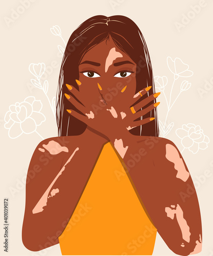 A young girl with Vitiligo skin problems covers her face with her hands. Body positive, self-love, depigmentation disease. World vitiligo day.