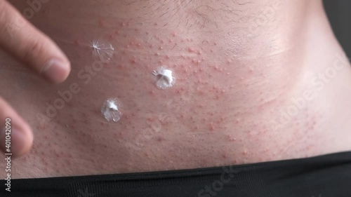 Man is applying ointment on itchy skin irritation with red spots, closeup view. Part of body in black pants. The concept of venereal diseases. Allergies, psoriasis, insect bite. Itchy skin irritation. photo