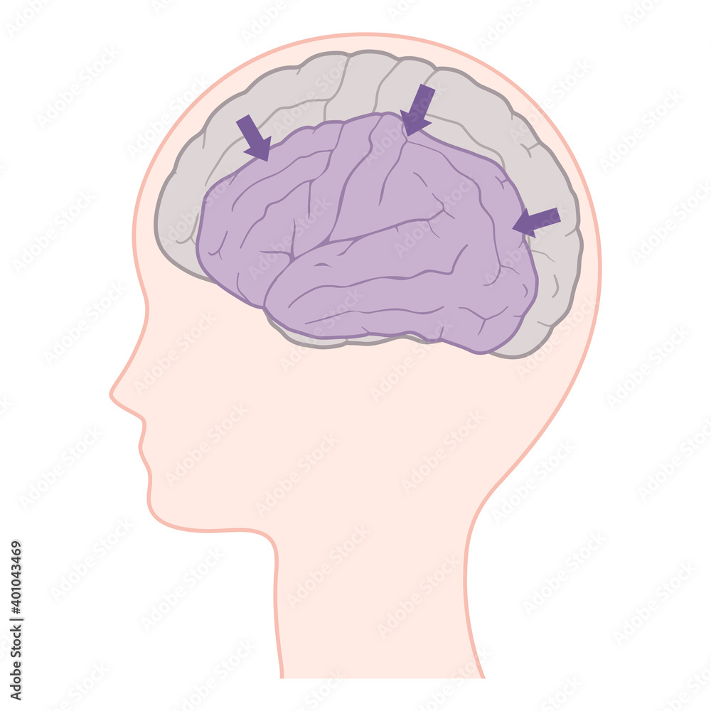 脳萎縮 アルツハイマー型認知症の脳のイラスト Stock Vector Adobe Stock