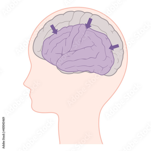脳萎縮_アルツハイマー型認知症の脳のイラスト